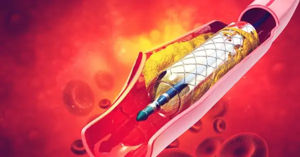 Stent - kiedy warto? Zabieg, rekonwalescencja i życie po