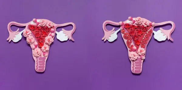Bolesne miesiączki - czy to adenomioza? Objawy, diagnoza, leczenie
