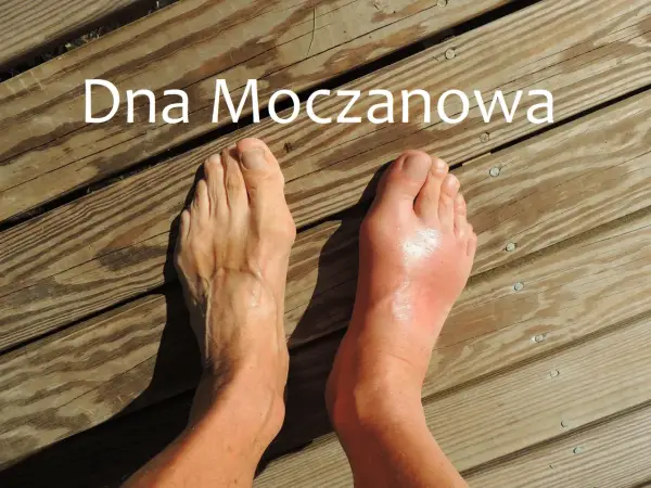 Dna moczanowa stopy - Jak rozpoznać atak i co robić?