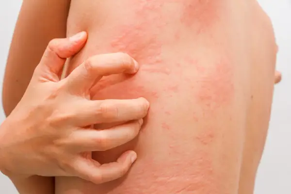 Salicylany - Nadwrażliwość? Rozpoznaj i ogranicz rozsądnie
