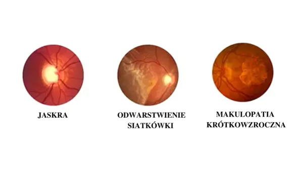 Krótkowzroczność - Rozpoznaj, koryguj i spowolnij progresję!