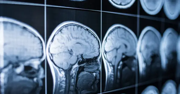 Śmierć mózgu - Diagnoza i skutki. Rozwiej wątpliwości