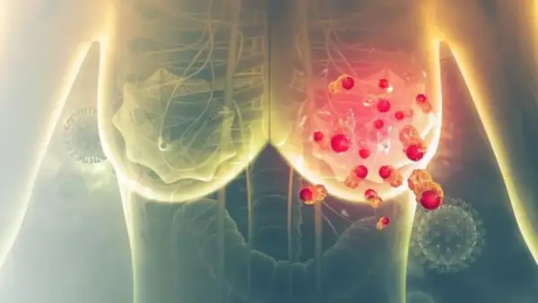 Trastuzumab - terapia celowana. Co musisz wiedzieć?