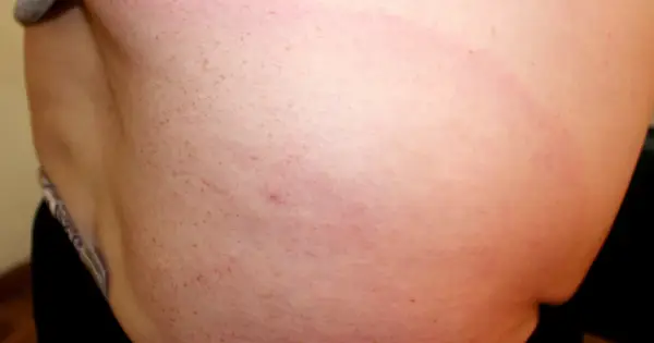 Odczyn po kleszczu - alergia czy rumień? Kiedy borelioza?
