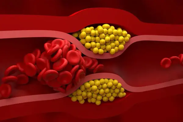 Cholesterol nie-HDL - interpretacja i co robić, gdy jest za wysoki
