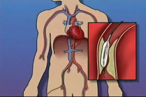 Angioplastyka i stent: Jak utrzymać drożność tętnic?