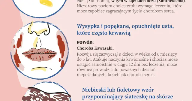 Ilustracja przedstawia twarz z wysypką i popękanymi ustami, objawy mogące wskazywać na chorobę Kawasaki, która bywa powiązana z chorobami serca.