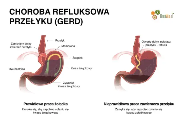 Ilustracja pokazuje prawidłowe i nieprawidłowe działanie zwieracza przełyku, wyjaśniając co na refluks żołądka.
